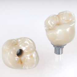 Screw retained crowns in zirconia emax or pfm